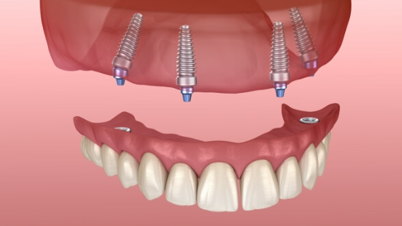 Illustrated denture being placed onto four dental implants in Mississauga